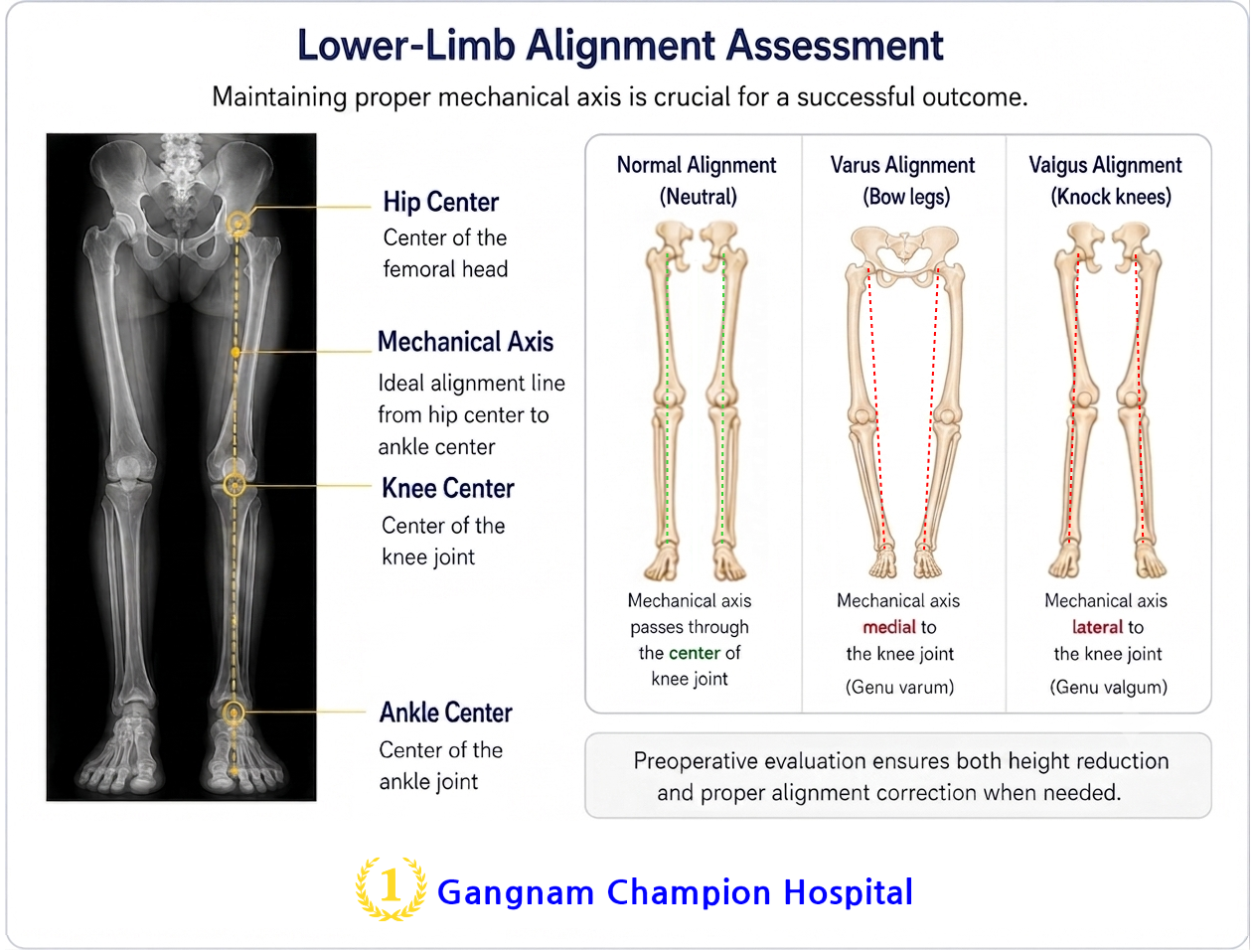 Full leg alignment and mechanical axis assessment before limb shortening surgery